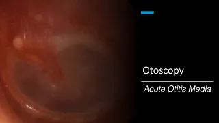 Acute Otitis Media: Otoscopy