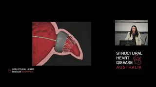 Procedural TOE Guidance for Left Atrial Appendage Occlusion - Dr Julie Humphries