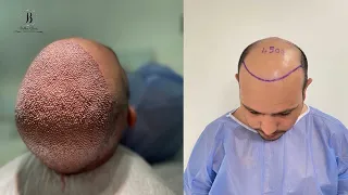 hair transplant in Bellus clinic / 5600 grafts per one session