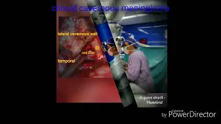 Clinoid cavernous meningioma