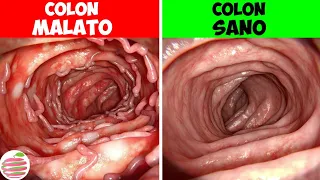 10 Modi Efficaci Per Mantenere Il Colon Sano