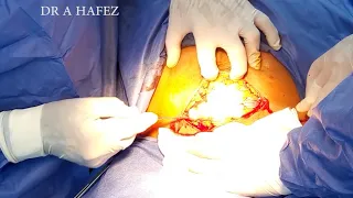 BEST CAESAREAN SECTION  TECHNIQUE