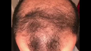 6 months using minoxidil - Rogaine 5% Before & After results