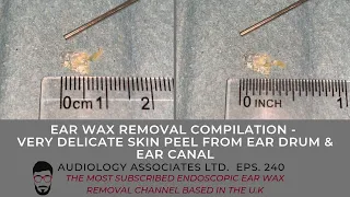 DELICATE SKIN PEEL FROM EARDRUM & EAR CANAL - EP 240