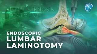 What is Endoscopic Lumbar Laminotomy? | Laminectomy