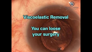 Viscoelastic Removal - Don't Loose your surgery. By Pedro Cabral MD