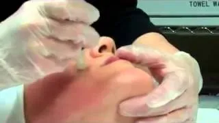 Dermapen Micro Needling Treatment