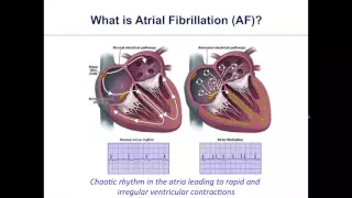 Patient Webinar: What Should You Know About Heart Valves & Atrial Fibrillation?