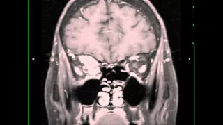 Solitary Fibrous Tumor of the Right Orbit