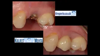 AnyRidge Implant Placement with Digital Planning.