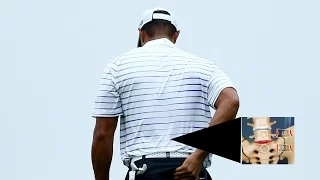A look at Tiger Woods' L5/S1 spinal fusion back surgery