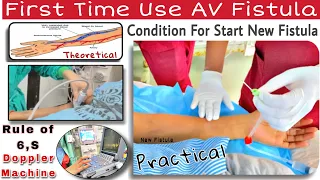New AV Fistula Start | First Time Use of AV fistula | Doppler of AV Fistula