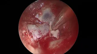 Endoscopic Optic Nerve Decompression @ Harshini Hospital Madurai