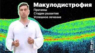 Макулодистрофия