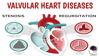 CVS Medicine Lecture 11 | Aortic Regurgitation (Aortic Insufficiency)