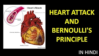 HEART ATTACK AND BERNOULLI'S PRINCIPLE