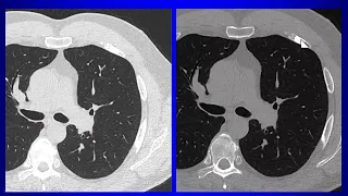 2 Solitary Pulmonary Nodule