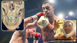 Jai Opetaia OUT A Year? | Jaw Broken BOTH SIDES In Briedis WIN | EASY Touch OR Unification Return?