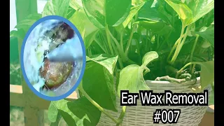 Ear Wax Removal By Professional doctor