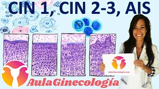 ALTERACIONES HISTOLÓGICAS EN EL CÉRVIX: CIN 1, CIN 2-3, AIS... - Ginecología y Obstetricia -