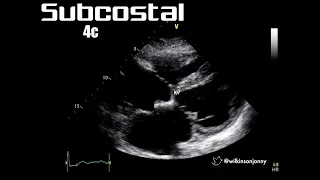 Subcostal 4 chamber view (SC4c)