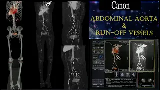 CT LOWER LIMB ANGIOGRAM || CT Scan of Abdominal Aorta Including Run-off Vessels. #basicradiology