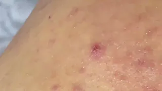 SAC DEP SPA Blackheads | #618