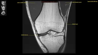 [Arabic]Chapter 5 - Lesson 11 - Knee joint MRI - مراجعة وقراءة صورة رنين مغناطيسي للركبة