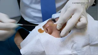 Nose Thread Lift with PDO Threads by Dr Lee Mun Heng