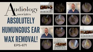 ABSOLUTELY HUMUNGOUS EAR WAX REMOVAL - EP671