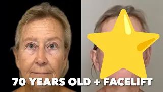 70 Year Old Facelift Patient Gets Amazing Results After Only 11 Days