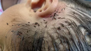 Remove thousand lice from brown hair - Getting out all hundred lice from hair