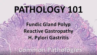 Fundic Gland Polyp, Reactive Gastropathy, and H. Pylori gastritis | Pathology 101| GI Pathology