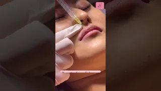 💋Improved Lip Shape by Fillers Live Procedure | #shorts #shortsfeed #lipfiller