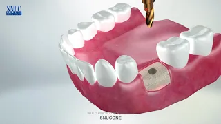 SNUCONE Dental Implant