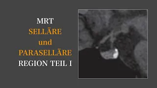 Selläre und paraselläre Region I Anatomie und Anomalien I Neuroradiologie I Gehirn I Brain & Synapse