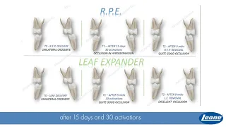 Leone Webinar Preview - R.P.E. Vs Leaf Expander