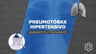 Pneumotórax Hipertensivo - Como Diagnosticar e Tratar