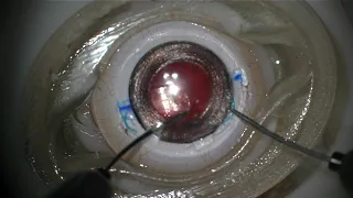 Scleral Fixated Intraocular lens  Wet lab