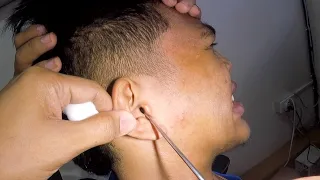 Something BLACK Trapped And Stuck in Man's Ear Removed