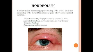 Diseases of Eyelids 2 Hordeolum (Hordeolum externum and Hordeolum Internum)