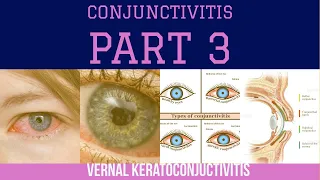 CONJUNCTIVITIS : PART - 3 | VERNAL KERATOCONJUNCTIVITIS | The White Army