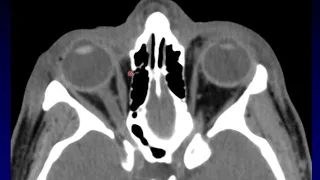 Imaging of the Eye and Orbit, Part 5