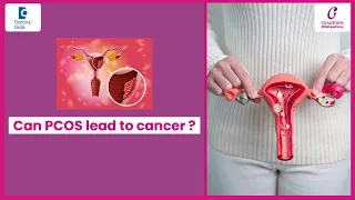 Can PCOS lead to cancer?|World Cancer Day-Dr.Deepthi Dandamudi of Cloudnine Hospitals|Doctors'Circle