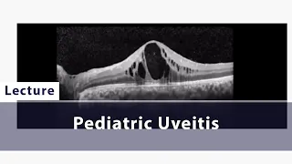 Pediatric Uveitis