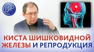 Киста шишковидной железы. Может ли киста шишковидной железы (киста эпифиза) влиять на репродукцию?