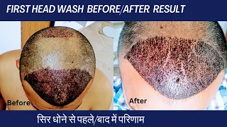 Day 5: My First Head wash After Hair Transplant at Home | Important day |  @hairtransplantstory