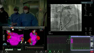 PR 2022, APRIL 25, Live demonstrations III – AF and atrial tachycardia ablation, Part D