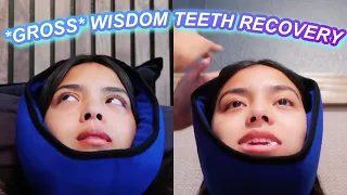 Twin Wisdom Teeth Recovery *GROSS*