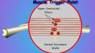 03_What is a Muscle Trigger Point?